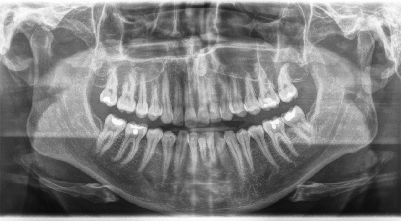 Фото Рентгена Здоровых Зубов