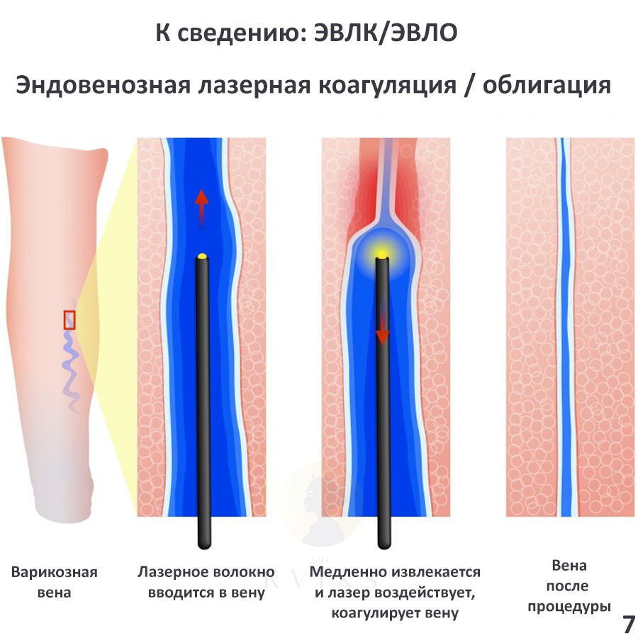 Лечение Варикоза Лазером В Твери