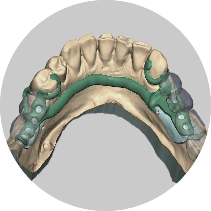 Exocad Partialcad