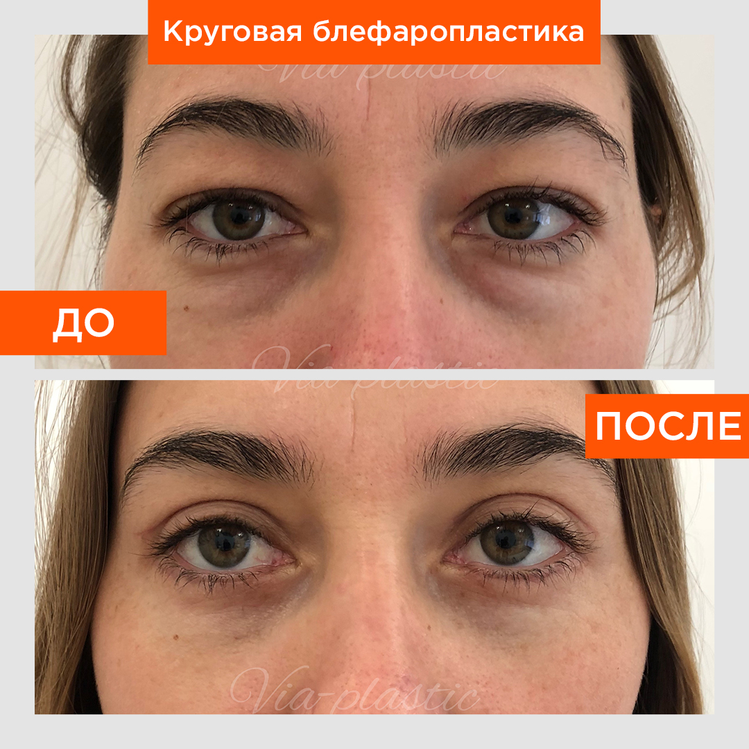 Джелкинг До И После Фото Отзывы Результаты — Картинки фотографии