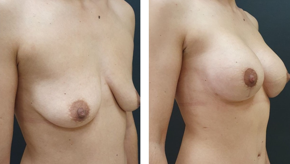 изменение груди с возрастом у женщин фото 48