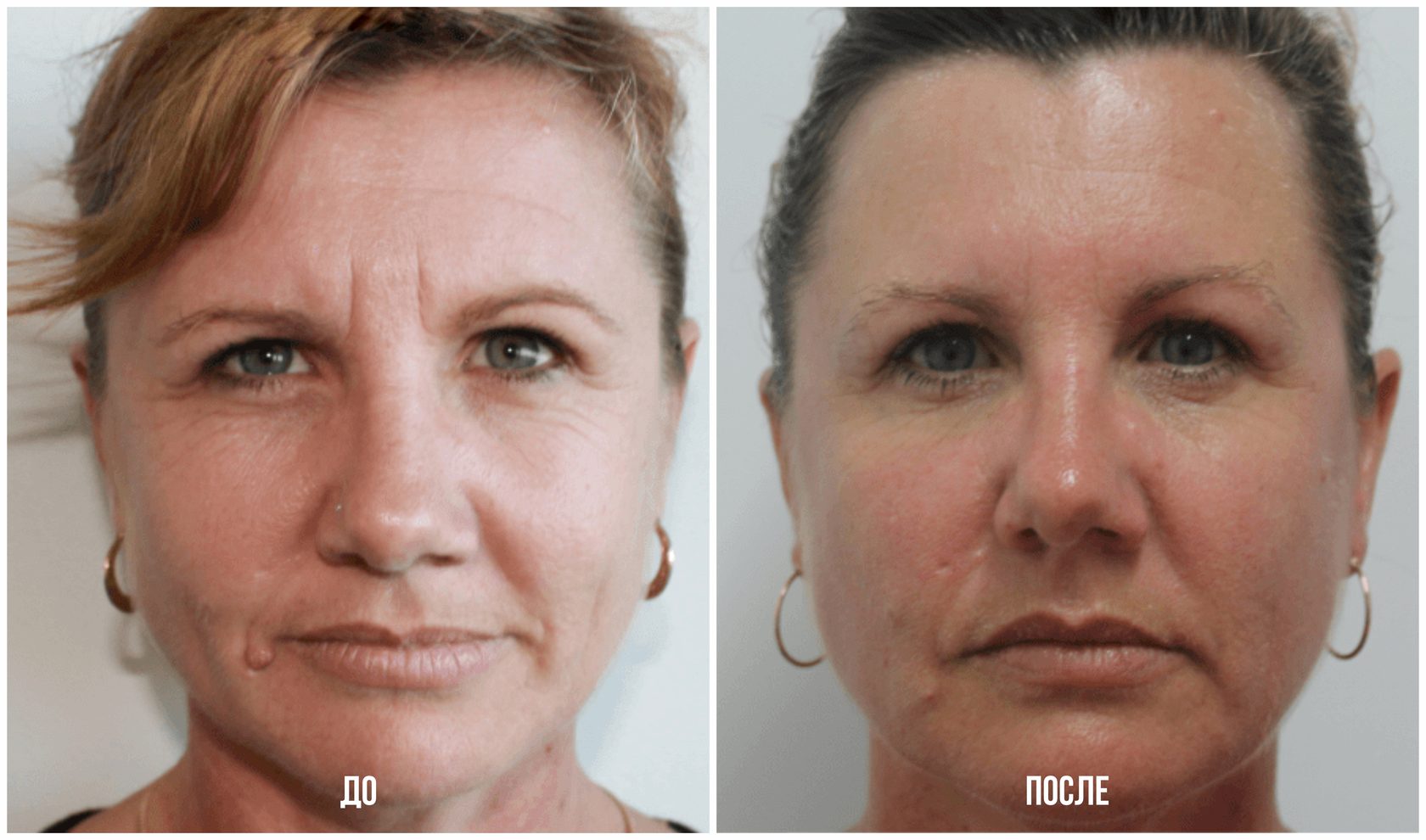 Фототерапия лица до и после фото