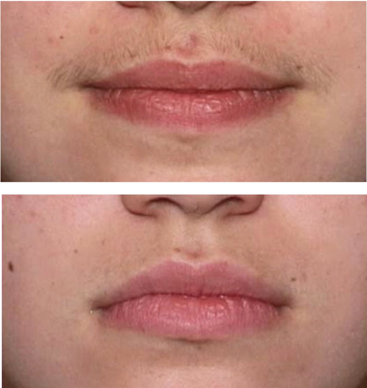 Women facial hair removal insurance coverage