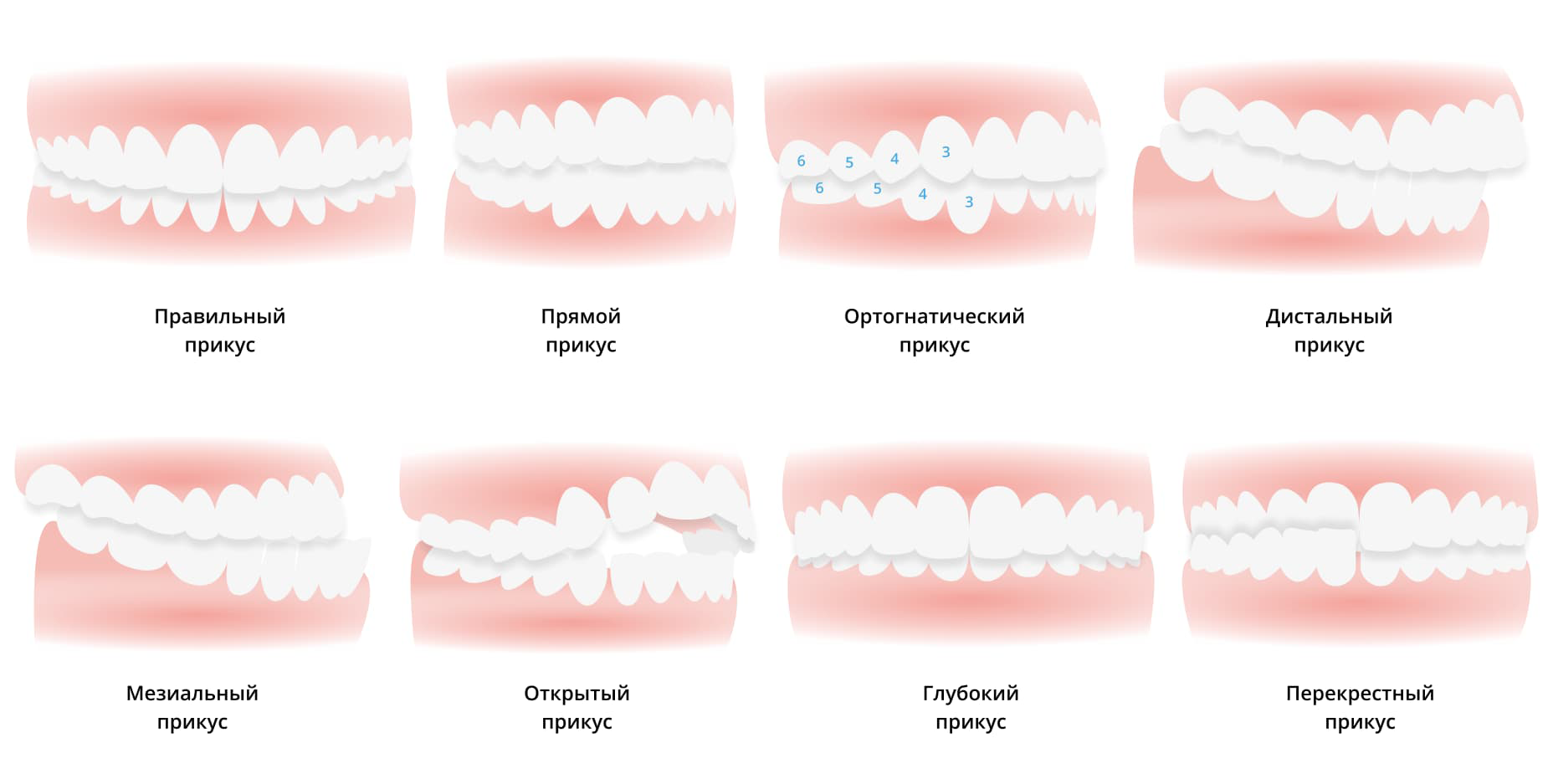 Клещеобразный прикус