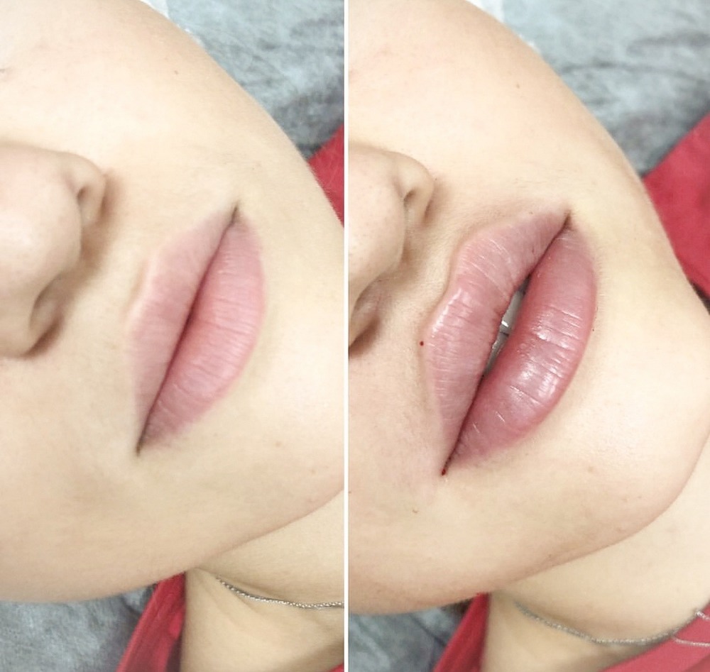 сделанные губы фото до и после