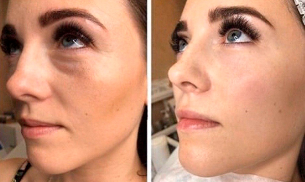 Как убрать синяки под глазами косметология до и после фото