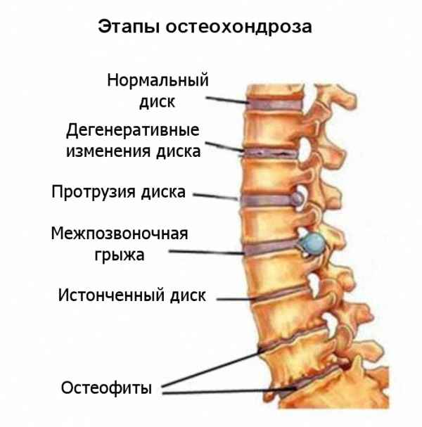 Что такое межпозвоночный шейный остеохондроз Что такое межпозвоночный шейный остеохондроз