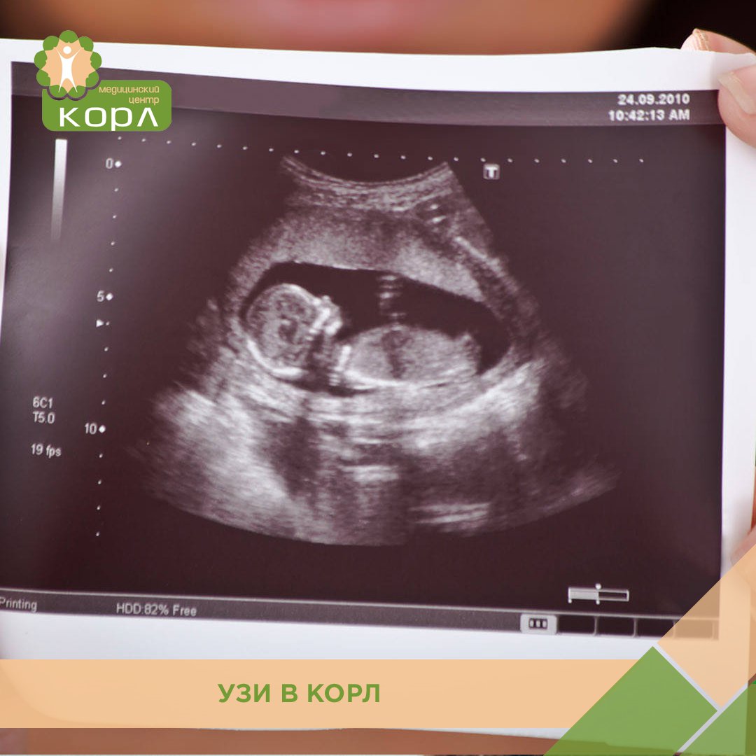 Пол ребенка по сердцебиению в 12 Пол ребенка по сердцебиению в 12