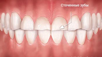 Края зубов сточены Края зубов сточены