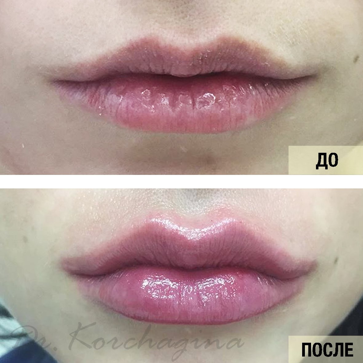 Ограничение после увеличения губ гиалуроновой кислотой Ограничение после увеличения губ гиалуроновой кислотой
