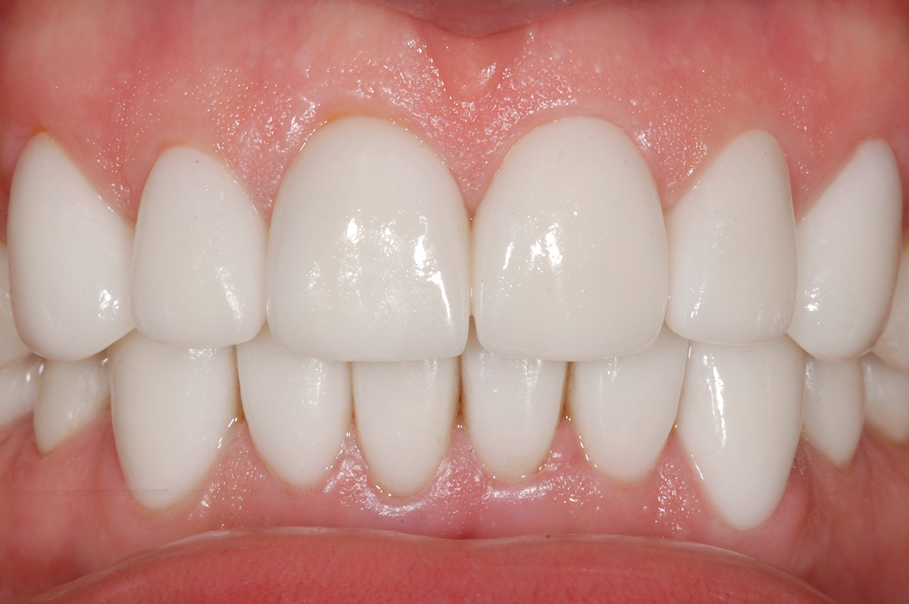 фото восстановленных зубов