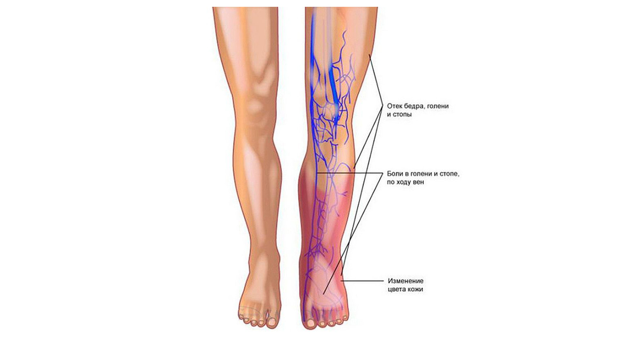 Варикоз Вен На Ногах И Тромбофлебит