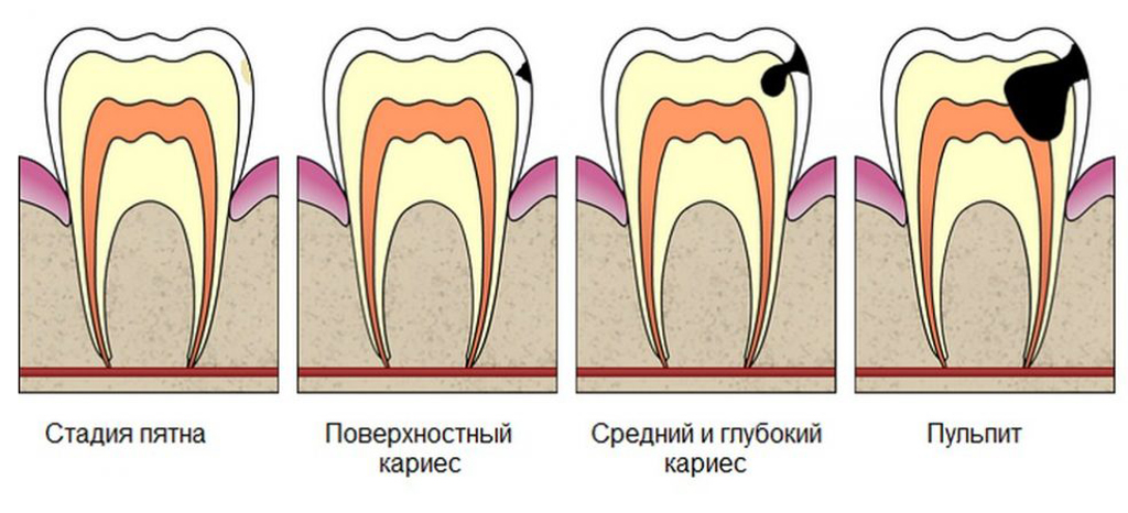 Рассмотрите рисунки 1 4 с изображением зуба человека как называется заболевание зуба стадии развития