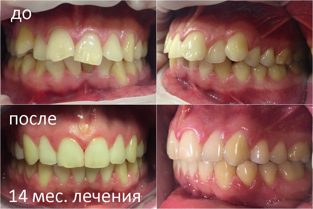 Зачем нужна капа для зубов Зачем нужна капа для зубов