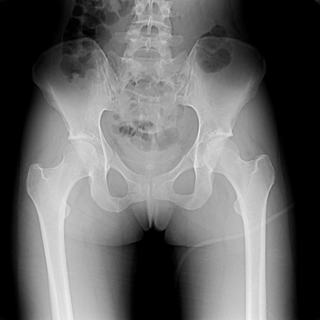 Перелом подвздошной кости таза рентген