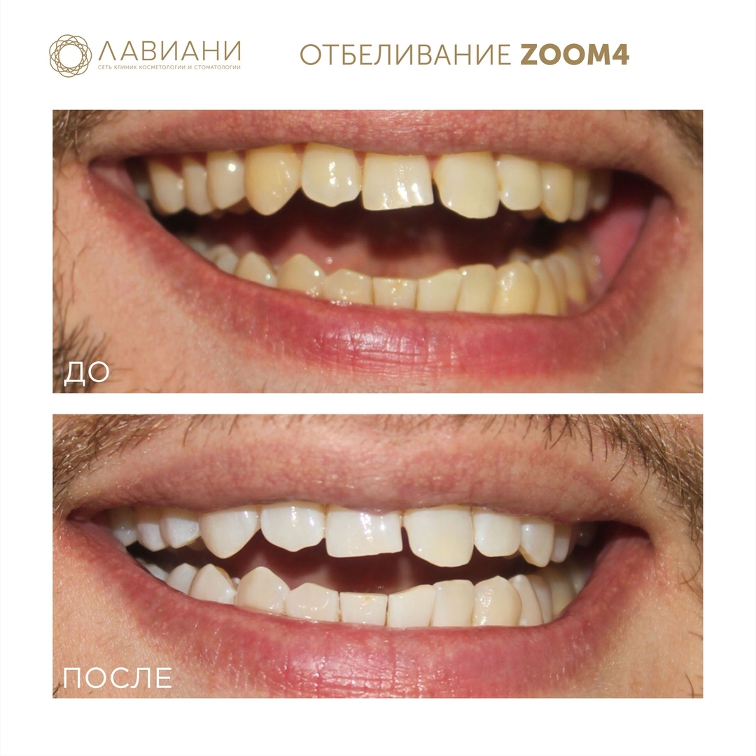 Отбеливание зубов Zoom 4 до и после