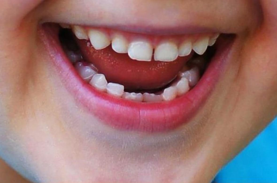 Детские Зубы С Кариесом Фото — Фото Картинки