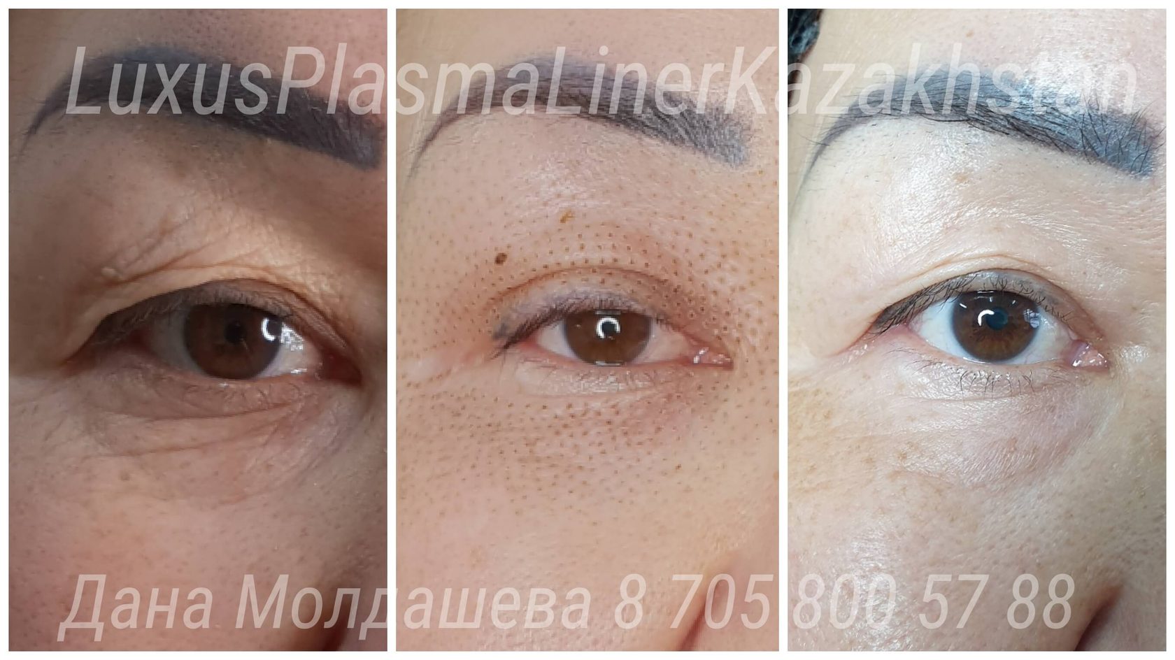 Luxus Plasma Liner плазменное омоложение век