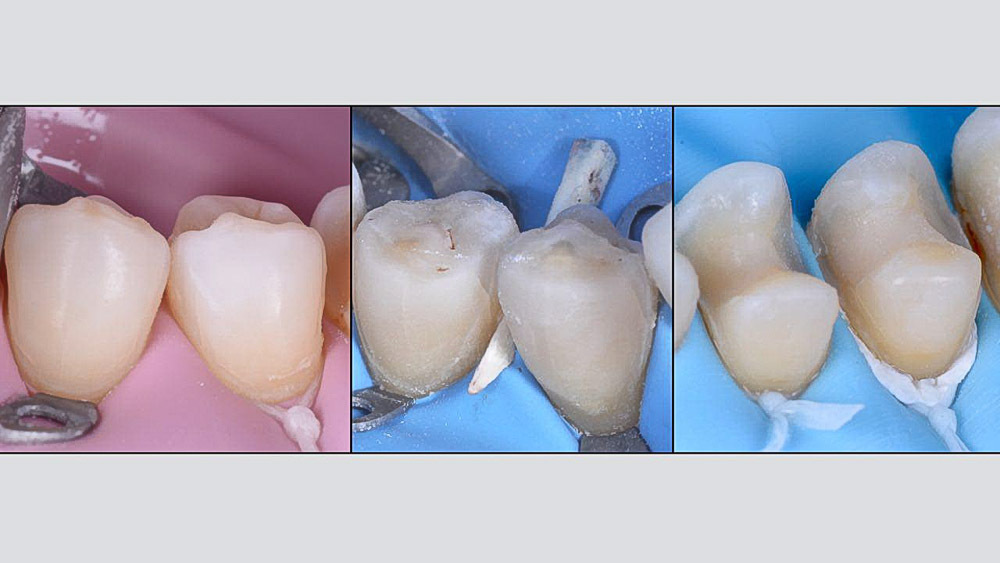 Обточка Зубов Под Виниры Фото — Mixyfotos.ru
