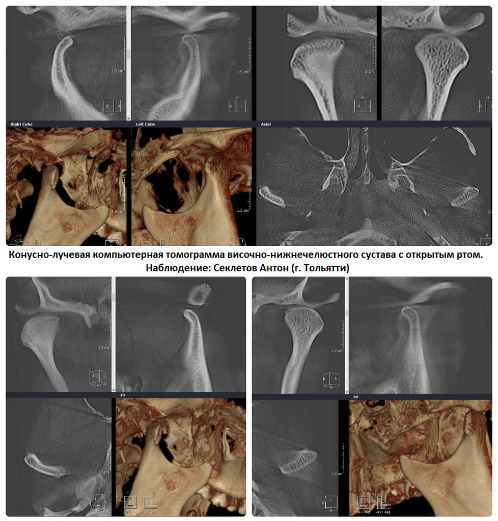 Кт челюсти и внчс