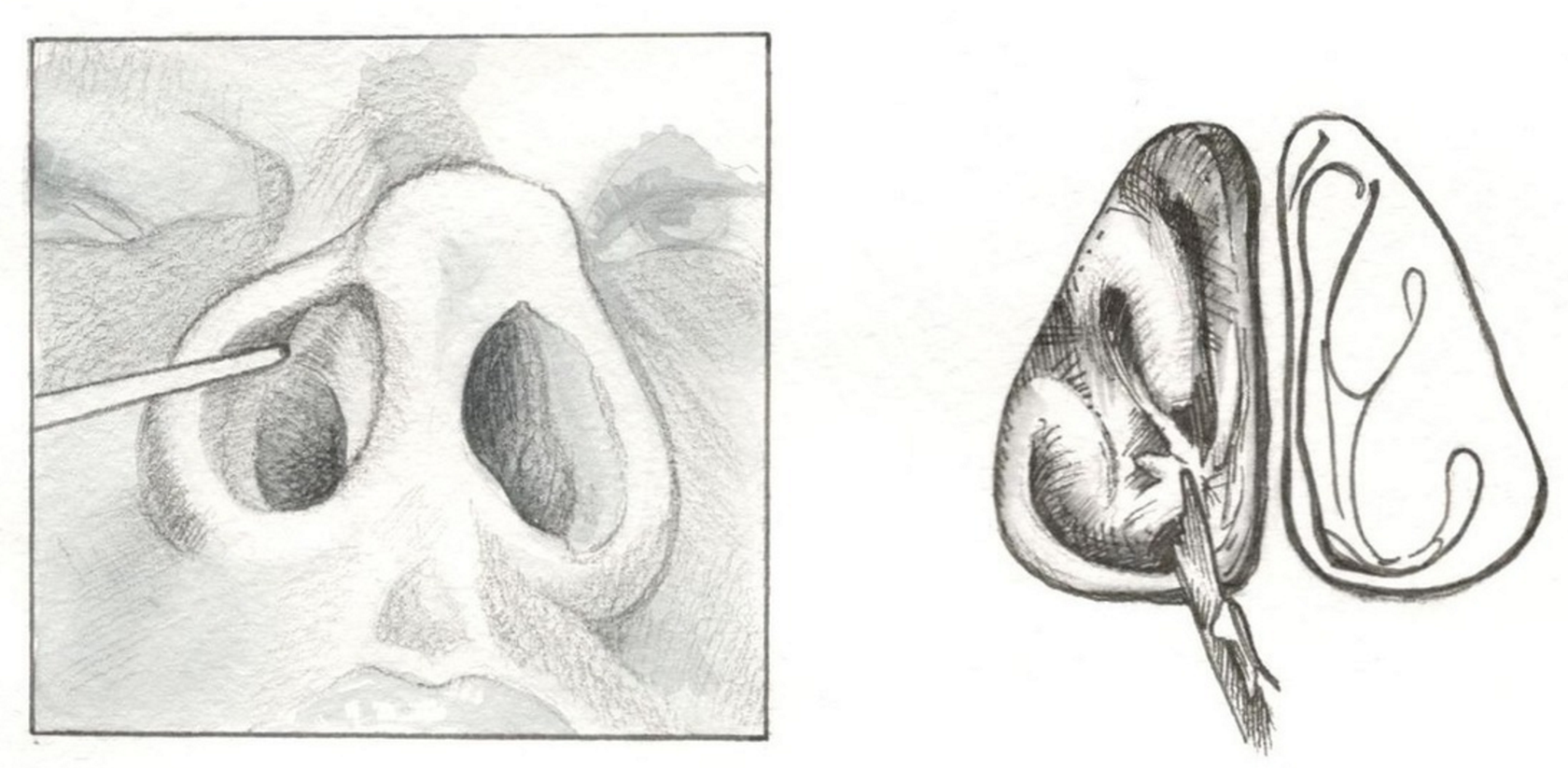 Женские малые половые губы. Синехии носовой перегородки. Синехии носовых раковин. Иссечение синехии в полости носа.