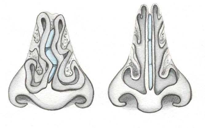 Почему не дышит нос