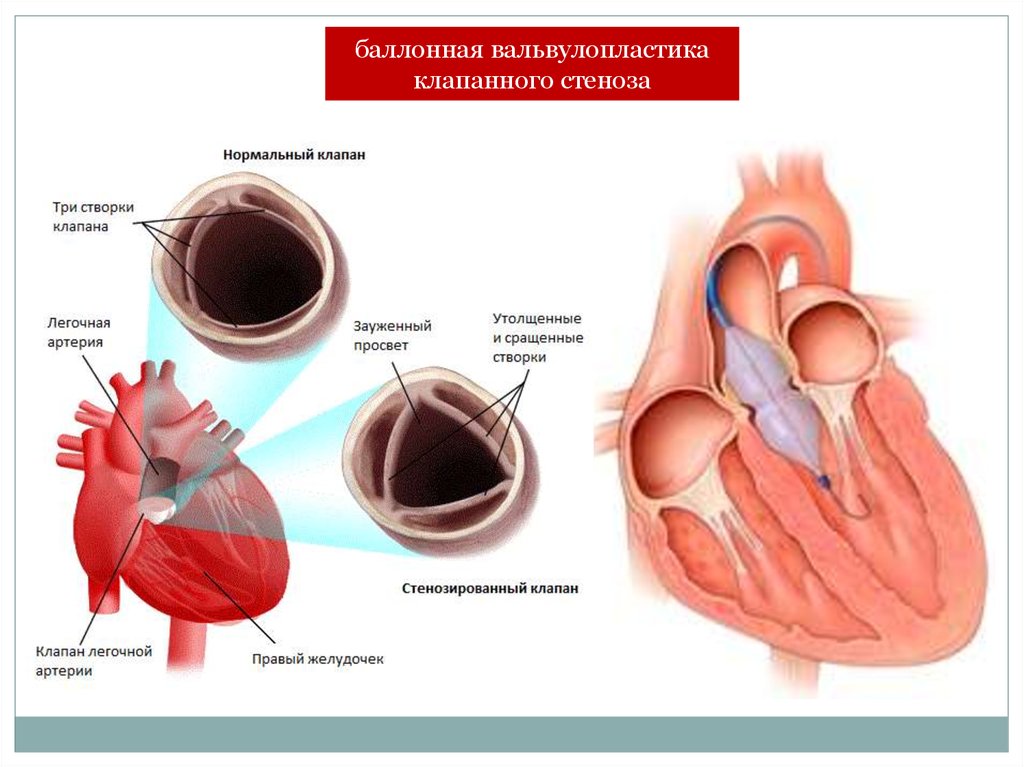 Аорта створки аортального клапана уплотнены. Вальвулопластика митральный стеноз. Вальвулопластика аортального клапана. Аортальный стеноз вальвулопластика. Баллонная дилатация митрального клапана.