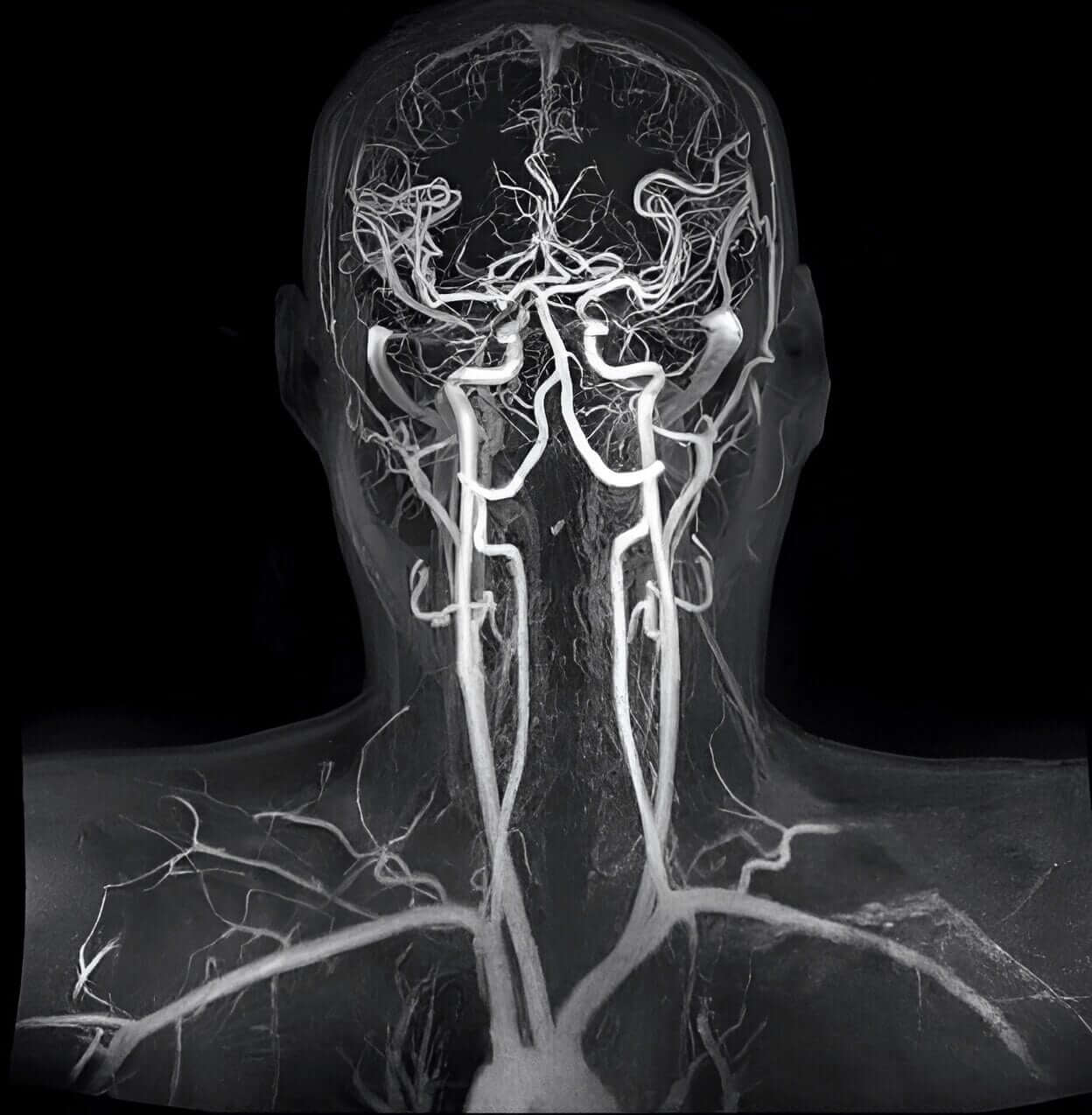 Кт сосудов головы и шеи. Кт ангиография брахиоцефальных артерий. Мрт ангиография артерий головного мозга. МР-ангиография сосудов головного мозга. Компьютерно-томографическая ангиография сосудов головного мозга.
