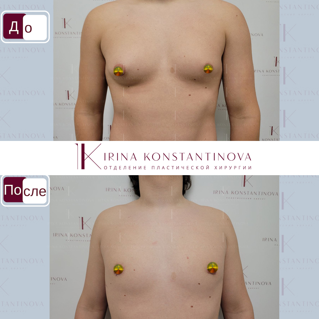 изменение груди у мужчин фото 95