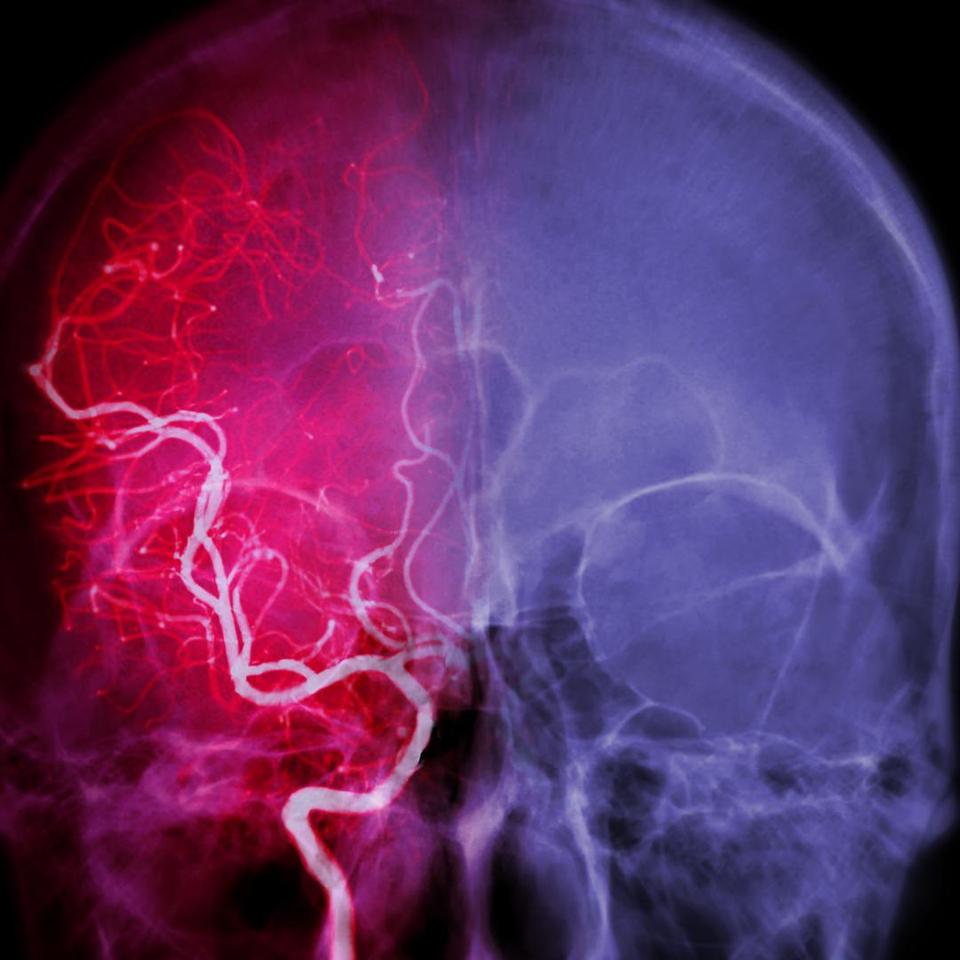 Stroke Risk Check: MRI + MRA Brain (1.5 T) – What's included