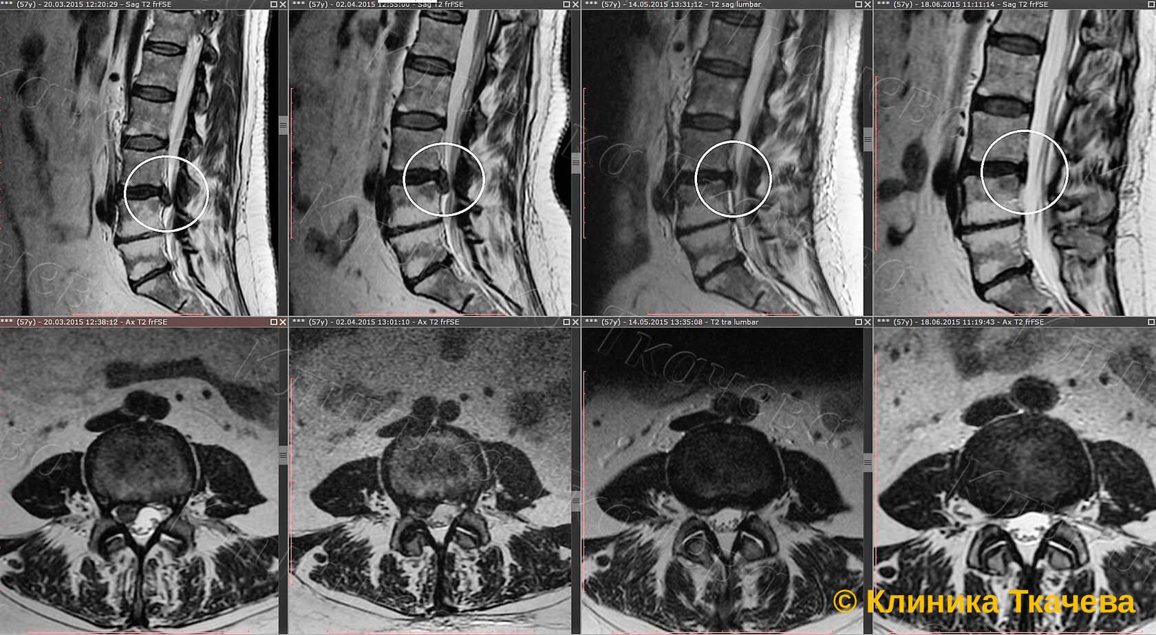 Рецидив грыжа диска. Межпозвоночная грыжа операция. Как выглядит грыжа на мрт поясничного отдела. Секвестрированная грыжа диска после операции. Рецидив грыжа диска.