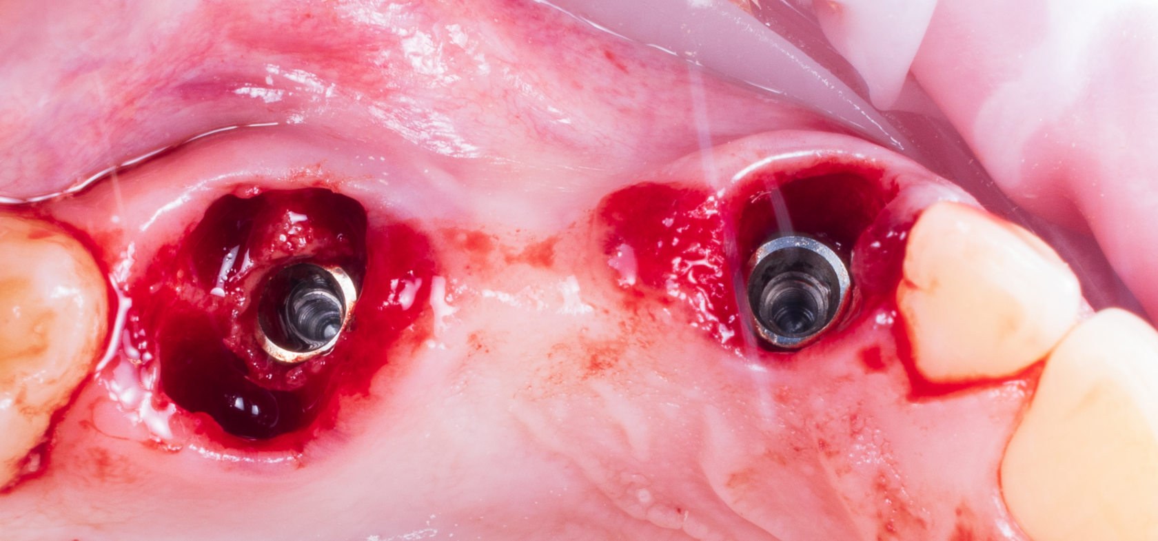 Рис. 1. Излишки костной ткани вокруг установленного имплантата