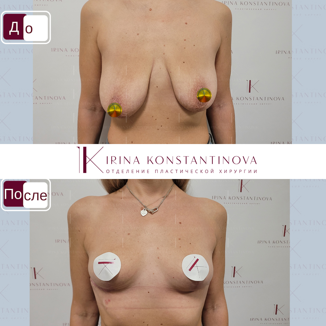 подтяжка груди с гантелями для женщин фото 1