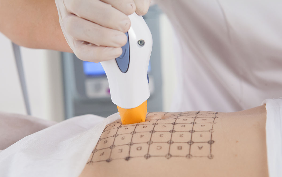 Процедура Thermage CPT по телу
