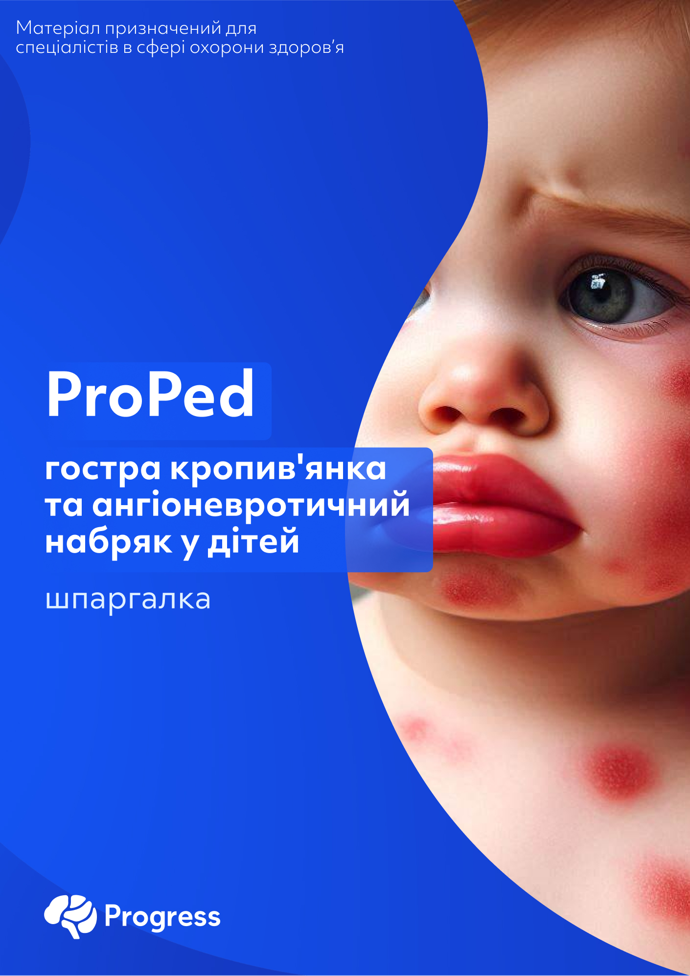 Шпаргалка ProPed: гостра кропив'янка та ангіоневротичний набряк у дітей