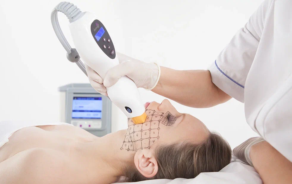 Процедура Thermage CPT по лицу