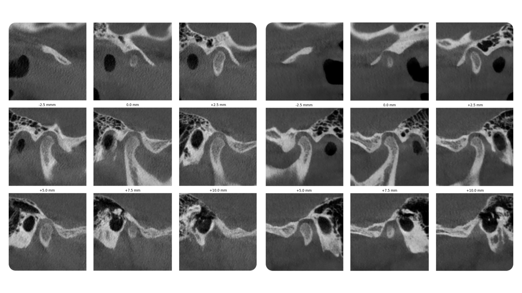 Generated temporomandibular joint sections