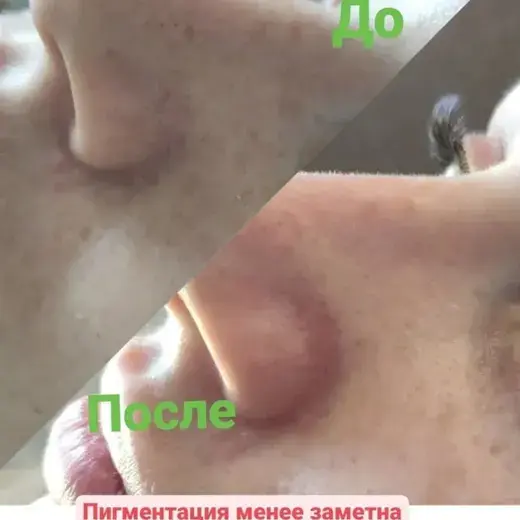 УЗ-чистка лица: до и после
