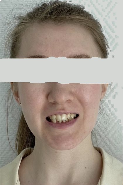 Улыбка до лечения