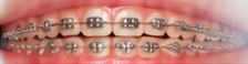metal