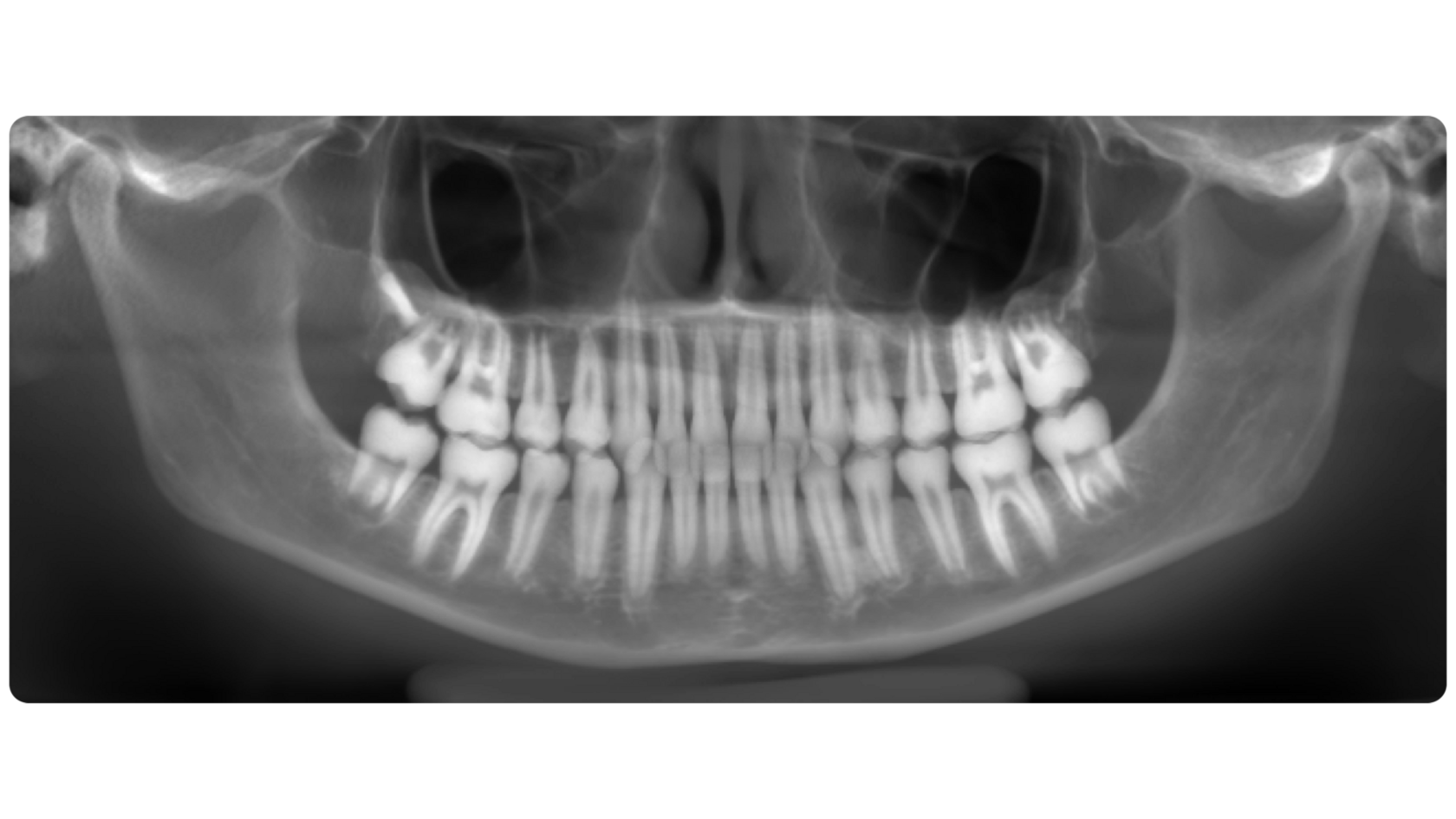 Panoramic reconstruction from a CBCT scan