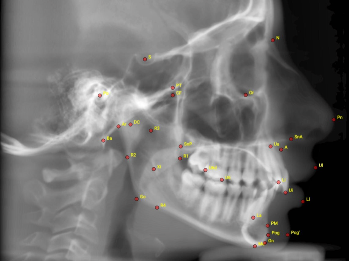 DentalMesh cephalometric landmarks and tracing