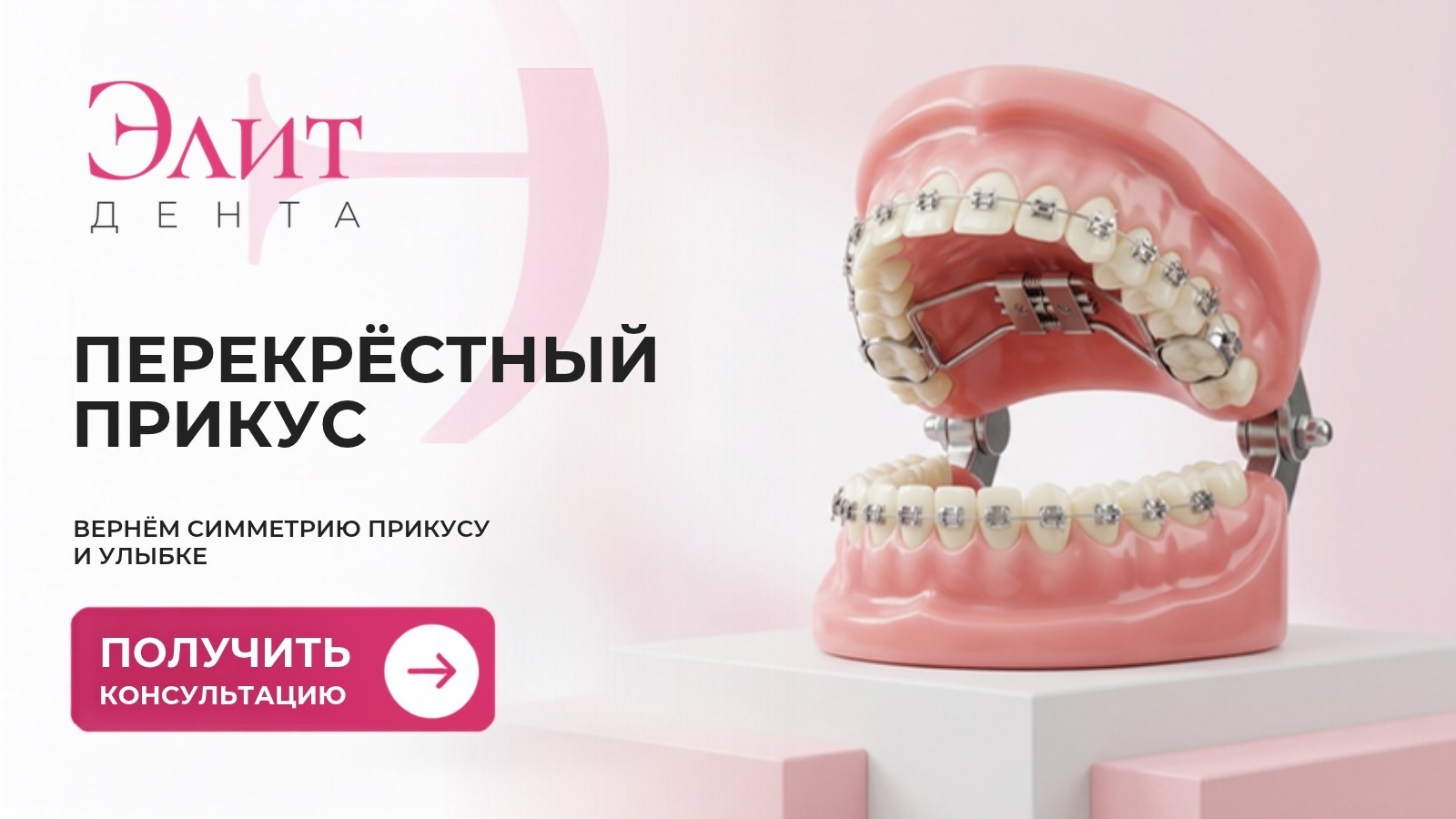 Перекрёстный прикус — модель челюстей с брекетами и расширяющим аппаратом