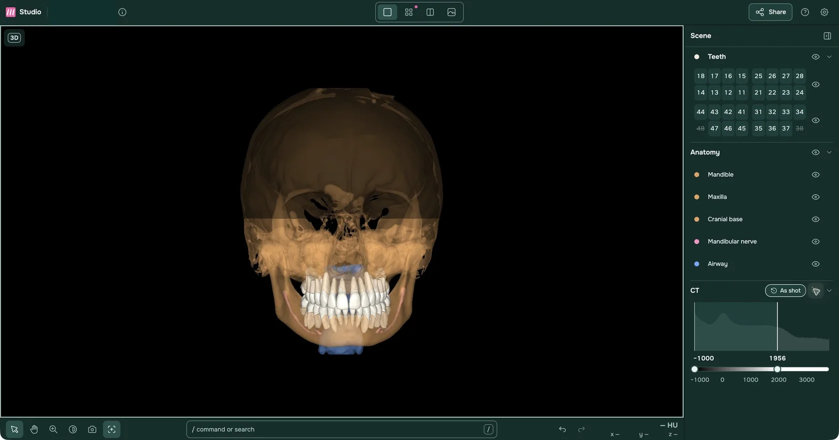 Teeth, bone, mandibular nerve and airway in 3D.