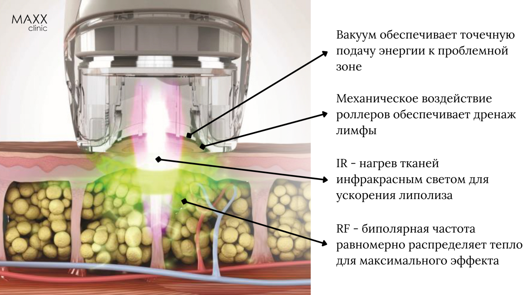 Коррекция фигуры VelaShape