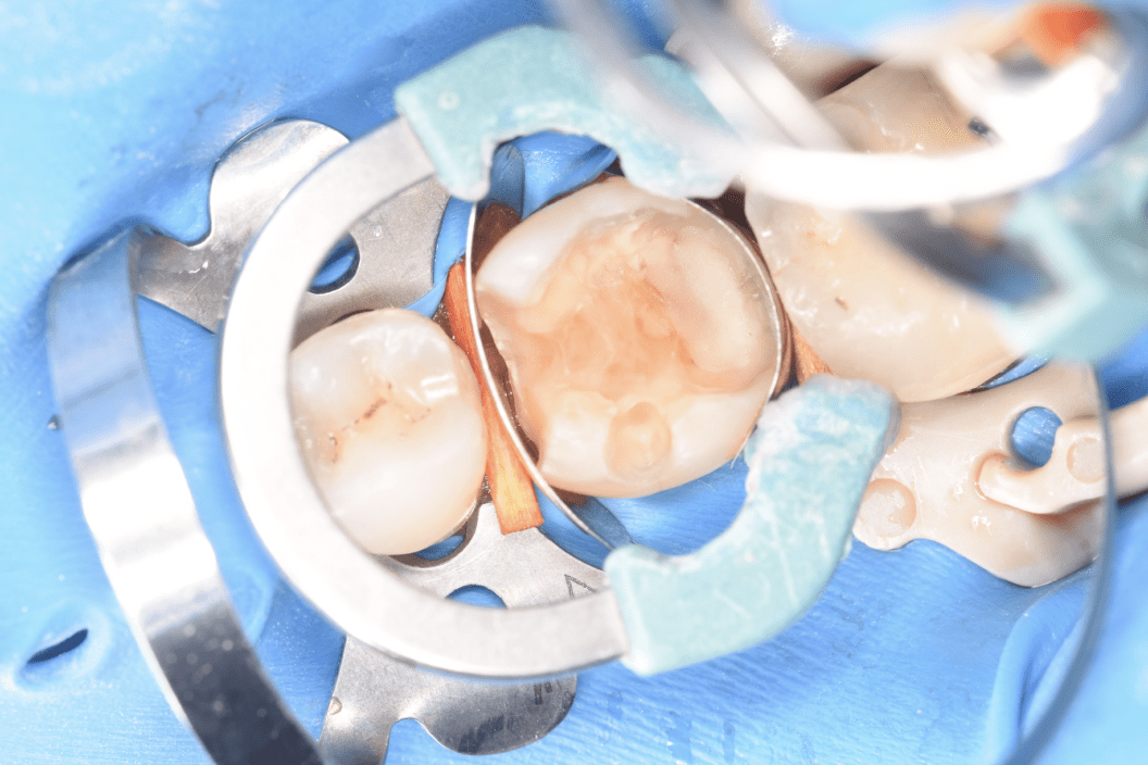 Лечение кариеса зуба - район Раменки - стоматология