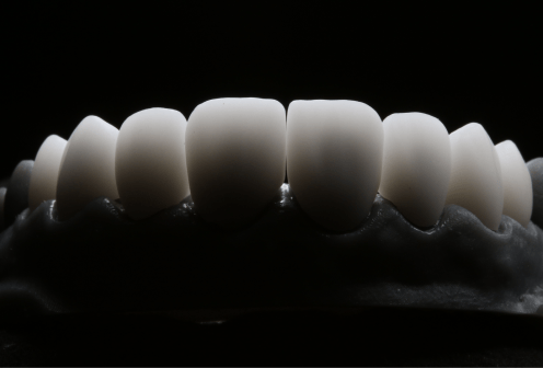Установка и замена виниров в стоматологической клинике Пробел