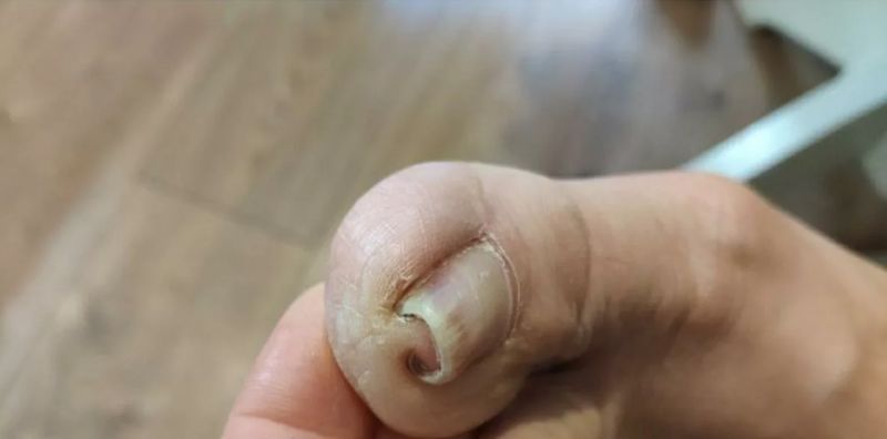 Утолщенные ногти на ногах: лечение и профилактика в Киеве