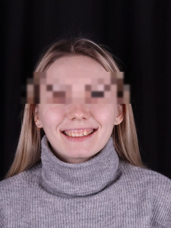 Исправление прикуса — фото до лечения, Elite Denta