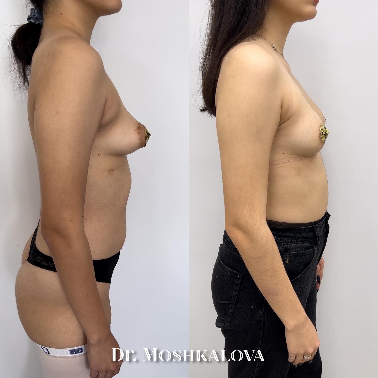 асимметрия груди женщин фото 26